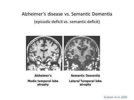 Medio temporal lobe atrophy Lateral Temporal lobe atrophy