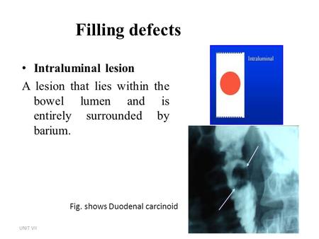 Filling defects Intraluminal lesion A lesion that lies within the bowel lumen and is entirely surrounded by barium. UNIT VII1 Fig. shows Duodenal carcinoid.