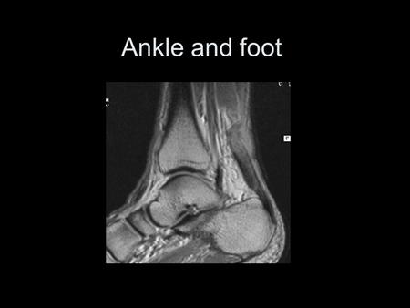 Ankle and foot Saggital slice mri.