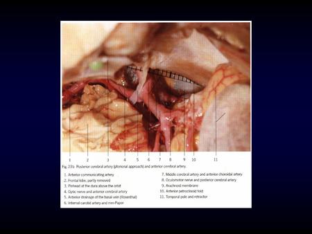 Basilar Artery Anterior inferior cerebellar artery Superior cerebellar artery Posterior cerebral artery –Posterior choroidal arteries Blood supply to.