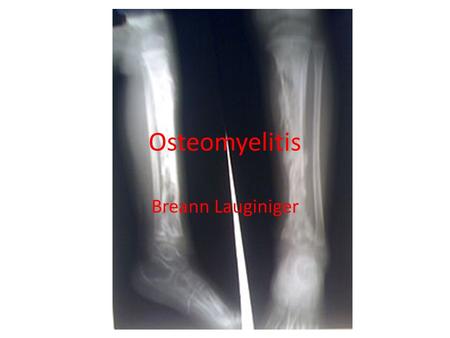 Osteomyelitis Breann Lauginiger.