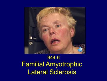 Familial Amyotrophic Lateral Sclerosis 944-6. Pseudobulbar Palsy Dysarthria and dysphagia Diminished palatal movement with positive gag bilaterally Diminished.