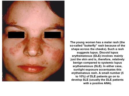 The young woman has a malar rash (the so-called butterfly rash because of the shape across the cheeks). Such a rash suggests lupus. Discoid lupus erythematosus.