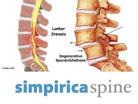 Degenerative Spondulolisthesis