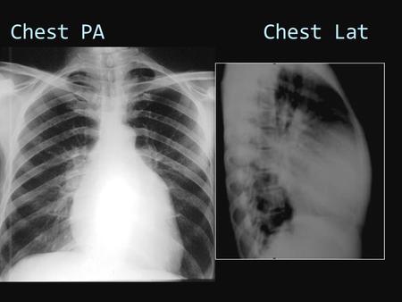 Chest PA Chest Lat. Chest PA Trachea Patient’s PA CXR Normal PA CXR (-) blunting of the costophrenic angle (-) pulmonary congestion (-) pulmonary infiltrates.