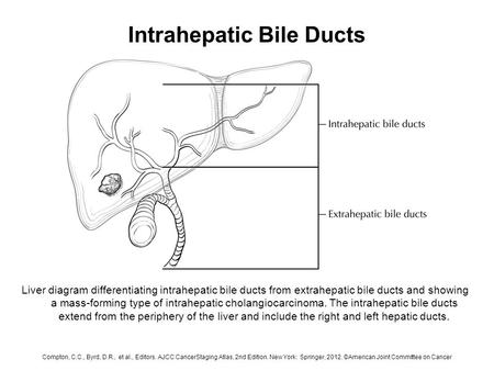 Intrahepatic Bile Ducts Liver diagram differentiating intrahepatic bile ducts from extrahepatic bile ducts and showing a mass-forming type of intrahepatic.