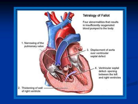 How To Look To Patient Data DATA History Taking o Growth o Exercise Intolerance o Recurrent Chest Infection o Syncopal Attacks o Squatting.