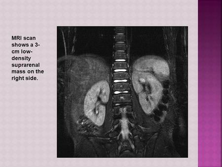 MRI scan shows a 3- cm low- density suprarenal mass on the right side.