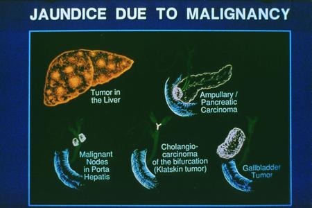 Pancreatic Cancer L. Okolicsanyi G. Morana Pancreas Cancer l 2nd most common GI malignancy l 30,000 cases per year in US l 25,000 deaths per year l 4.