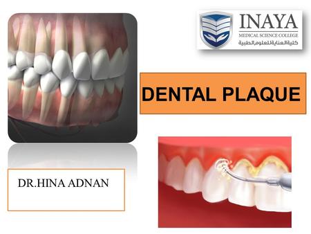 DENTAL PLAQUE DR.HINA ADNAN.