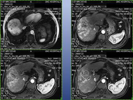 Hepatocellular Carcinoma from the ACC to Med E Paul M. Johnson Department of Internal Medicine University of North Carolina Hospitals February 12, 2010.