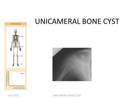 UNICAMERAL BONE CYST JULY 2012UNICAMERAL BONE CYST.