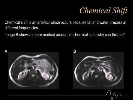 1 Chemical Shift Image B shows a more marked amount of chemical shift, why can this be? Chemical shift is an artefact which occurs because fat and water.