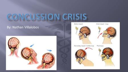 Concussion Crisis By: Nathan Villalobos.