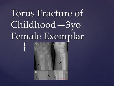 { Torus Fracture of Childhood—3yo Female Exemplar.