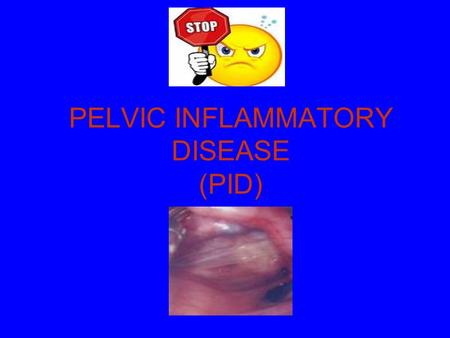 PELVIC INFLAMMATORY DISEASE (PID)