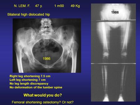 N. LEM. F. 47 y. 1 m50 49 Kg Bilateral high dislocated hip 1986 Right leg shortening 7.5 cm Left leg shortening 7 cm No leg length discrepancy No deformation.