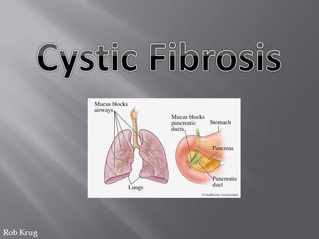 Rob Krug. CF is caused by a mutation in the gene “cystic fibrosis transmembrane conductance regulator” (CFTR). This gene is important in creating sweat,