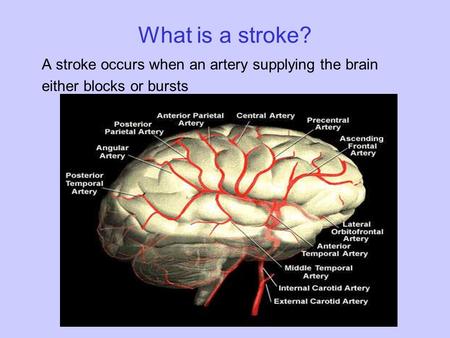 What is a stroke? A stroke occurs when an artery supplying the brain either blocks or bursts.