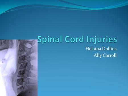 Helaina Dollins Ally Carroll. Description Spinal cord injuries usually begin with a blow that fractures or dislocates your vertebrae, the bone disks that.