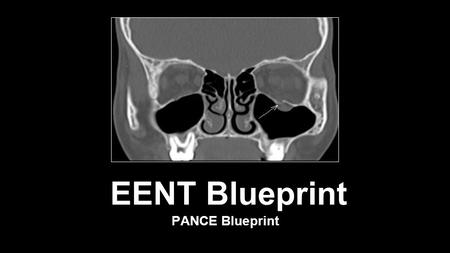 EENT Blueprint PANCE Blueprint. Eye Disorders Blepharitis Blepharitis is characterized by inflammation of the eyelids There is anterior and posterior.