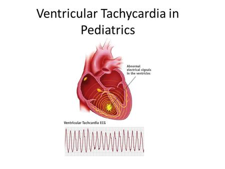 Ventricular Tachycardia in Pediatrics. Definition: tachycardia of at least 3 successive ventricular beats.