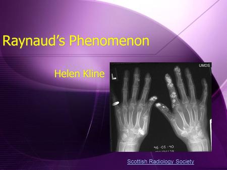 Raynaud’s Phenomenon Helen Kline Scottish Radiology Society.