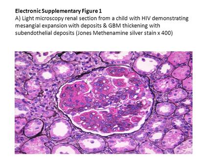 Electronic Supplementary Figure 1 A) Light microscopy renal section from a child with HIV demonstrating mesangial expansion with deposits & GBM thickening.