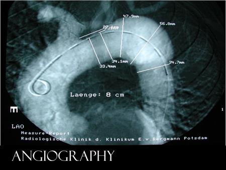 ANGIOGRAPHY. Your Hearts Electrical System Lubb The sinoatrial node fires. The signal is sent through to both atriums which contract pushing blood into.