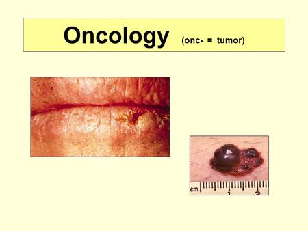 Oncology (onc- = tumor). Oncology (onco- = mass) -plasia = new development -trophy = growth –Changes in Growth sizeChanges in size of individual cell.