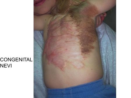 CONGENITAL NEVI. Common Malignant Neoplasms of Infancy and ChildhoodCommon Malignant Neoplasms of Infancy and Childhood 0 to 4 Years5 to 9 Years10 to.