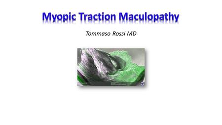 Tommaso Rossi MD. History 1999 Takano and Kishi identify Myopic Schisis without MH 2004 Panozzo and Mercanti use the term Myopic Traction Maculopathy.