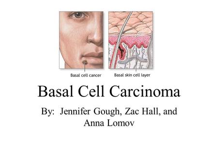 Basal Cell Carcinoma By: Jennifer Gough, Zac Hall, and Anna Lomov.