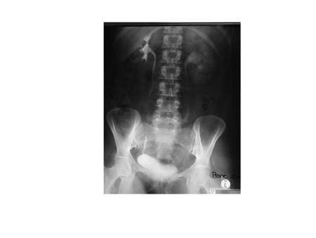 B-Late changes In severe degree of obstruction : The intrapelvic pressure becomes closure or higher than the glomerular filtration rate(6-12mm Hg), -less.