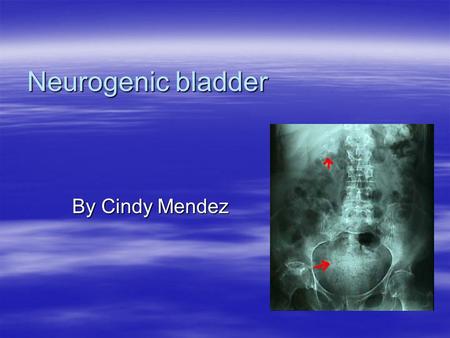 Neurogenic bladder By Cindy Mendez. ETIOLOGY  Loss of voluntary voiding control –Manifested by retention or incontinence  Caused by a lesion to the.