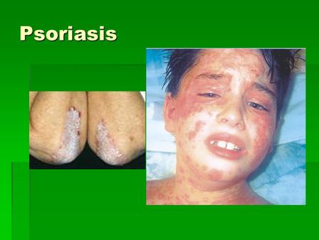 Psoriasis. What is psoriasis?  Psoriasis is a non-contagious genetic disease caused by the immune system which effects the skin and joints.  In plaque.