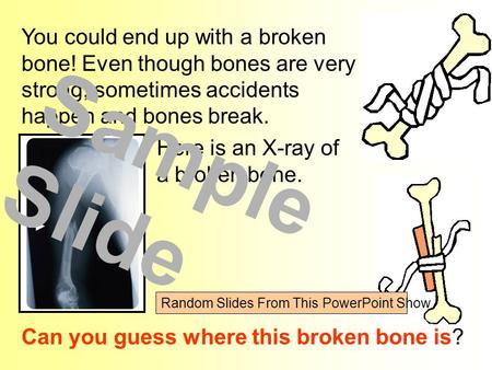 You could end up with a broken bone! Even though bones are very strong, sometimes accidents happen and bones break. Can you guess where this broken bone.