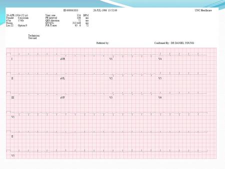 3 rd Degree AV block Jason Haag Heart Block 1 st Degree AV Block one-to-one relationship exists between P waves and QRS complexes, but the PR interval.