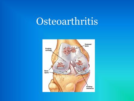 Osteoarthritis. What is osteoarthritis (OA)? Degenerative joint disease Slowly evolving disease Originates in the cartilage Causes inflammation of the.