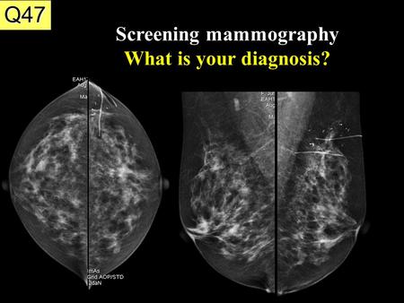 Screening mammography