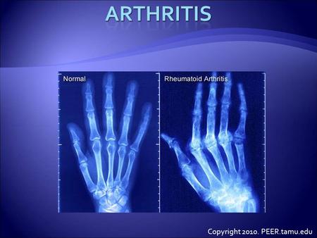 Copyright 2010. PEER.tamu.edu.  Do you know anyone that has arthritis?  Both humans and animals can get arthritis.  What is arthritis?  Arthritis.