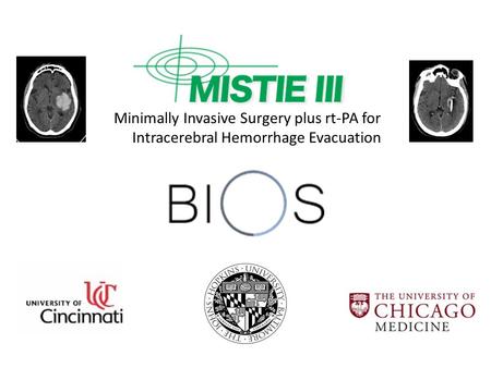 Minimally Invasive Surgery plus rt-PA for Intracerebral Hemorrhage Evacuation The concept of minimally invasive evacuation of an ICH has a good rationale.