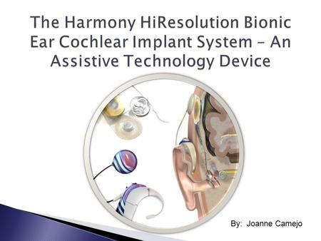 By: Joanne Camejo. A cochlear implant manufactured by Advanced Bionics, which maximizes the hearing potential of it’s recipients. It allows its recipients.