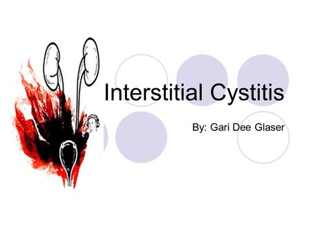 Interstitial Cystitis