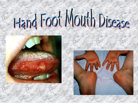 Hand Foot Mouth Disease