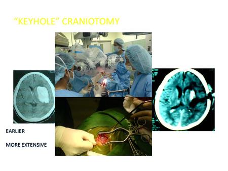 “KEYHOLE” CRANIOTOMY EARLIER MORE EXTENSIVE. Ultrasound Guided Aspiration +/- Thrombolytic Agent.