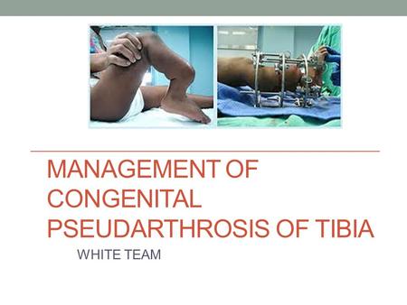 MANAGEMENT OF CONGENITAL PSEUDARTHROSIS OF TIBIA