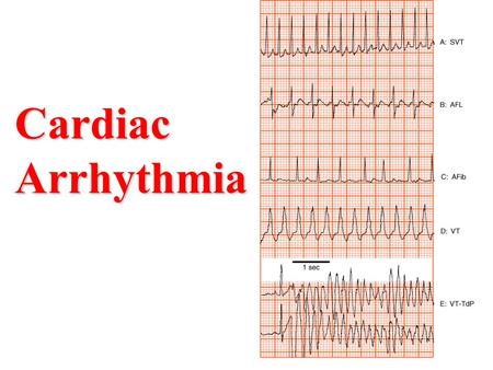 Cardiac Arrhythmia.