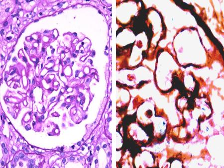 Membranous nephropathy Secondary causes: Epithelial malignancies, SLE, drugs (penicillamine), infections (Hep B, syphilis, malaria), metabolic (diabetes,