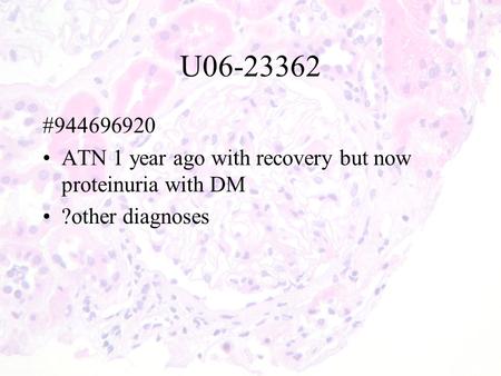 U06-23362 #944696920 ATN 1 year ago with recovery but now proteinuria with DM ?other diagnoses.